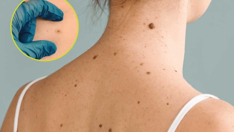 nape and back showing body moles