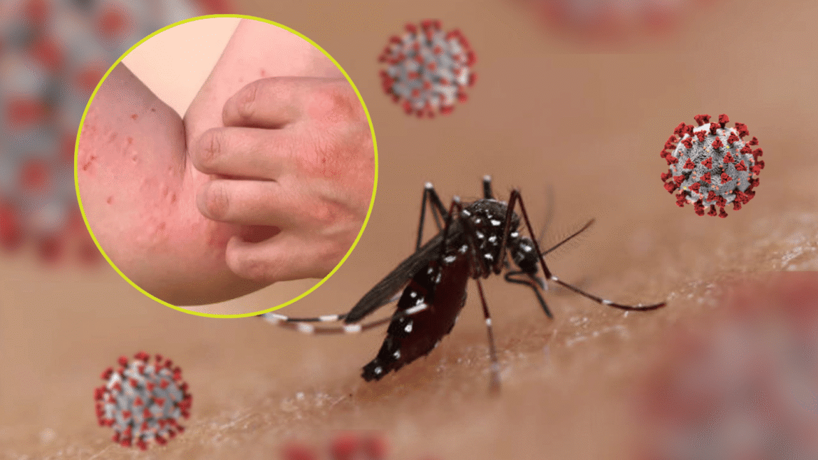 Chikungunya