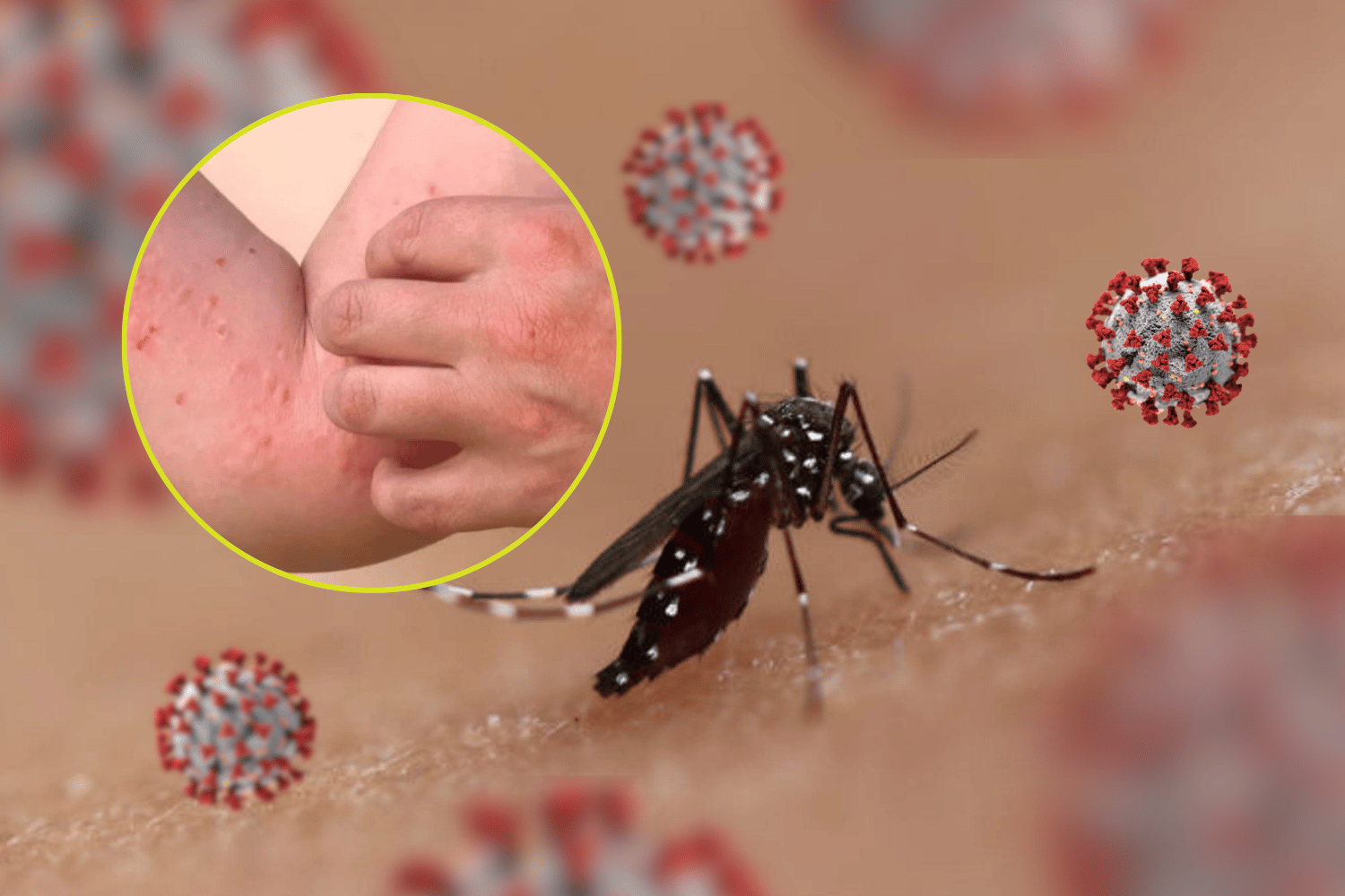 Chikungunya