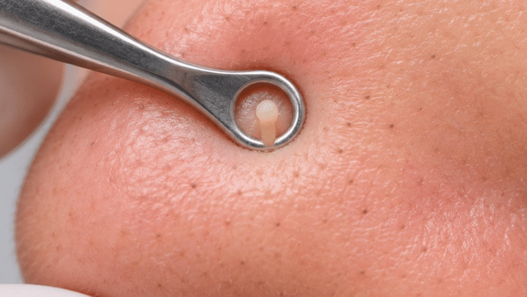 pimple-popping videos