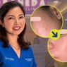 UNDER THE RADAR: An effective acne scar treatment that’s too good to keep secret